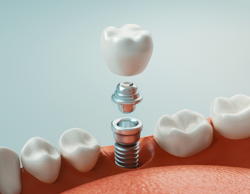 single dental implants near you