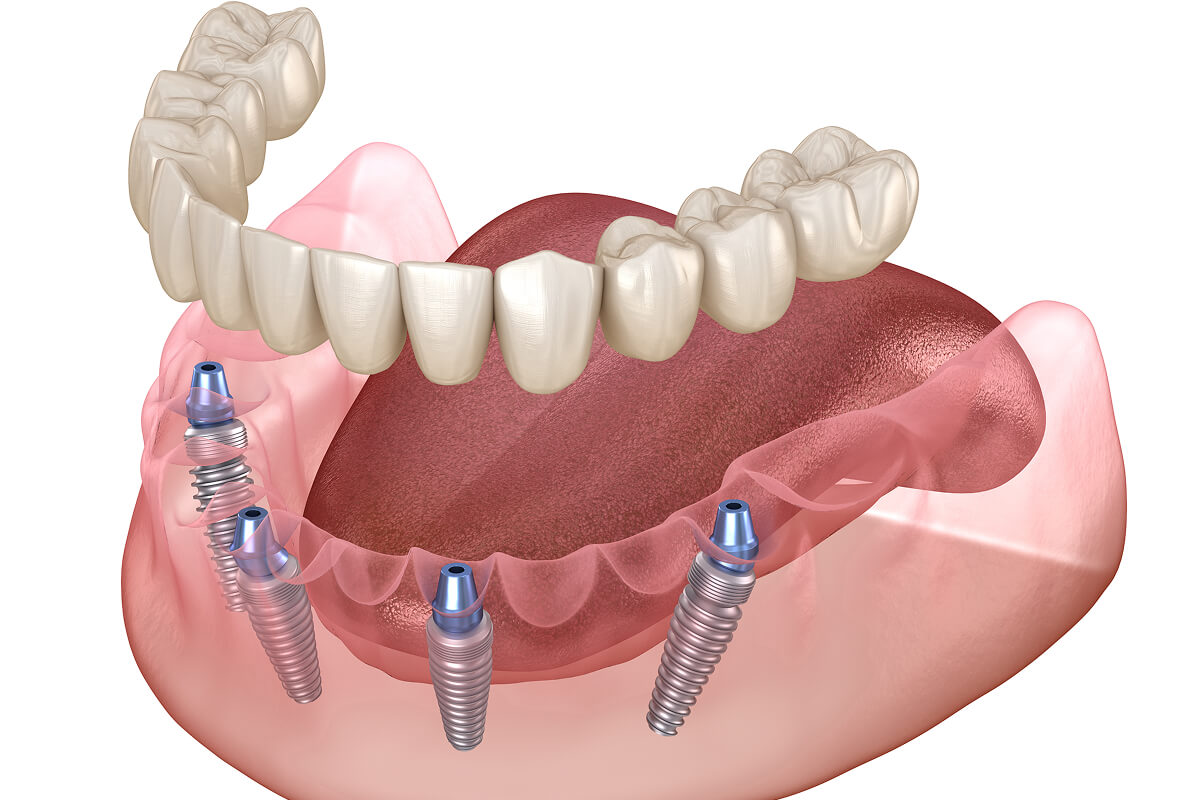 all-on-4 dental implants near you