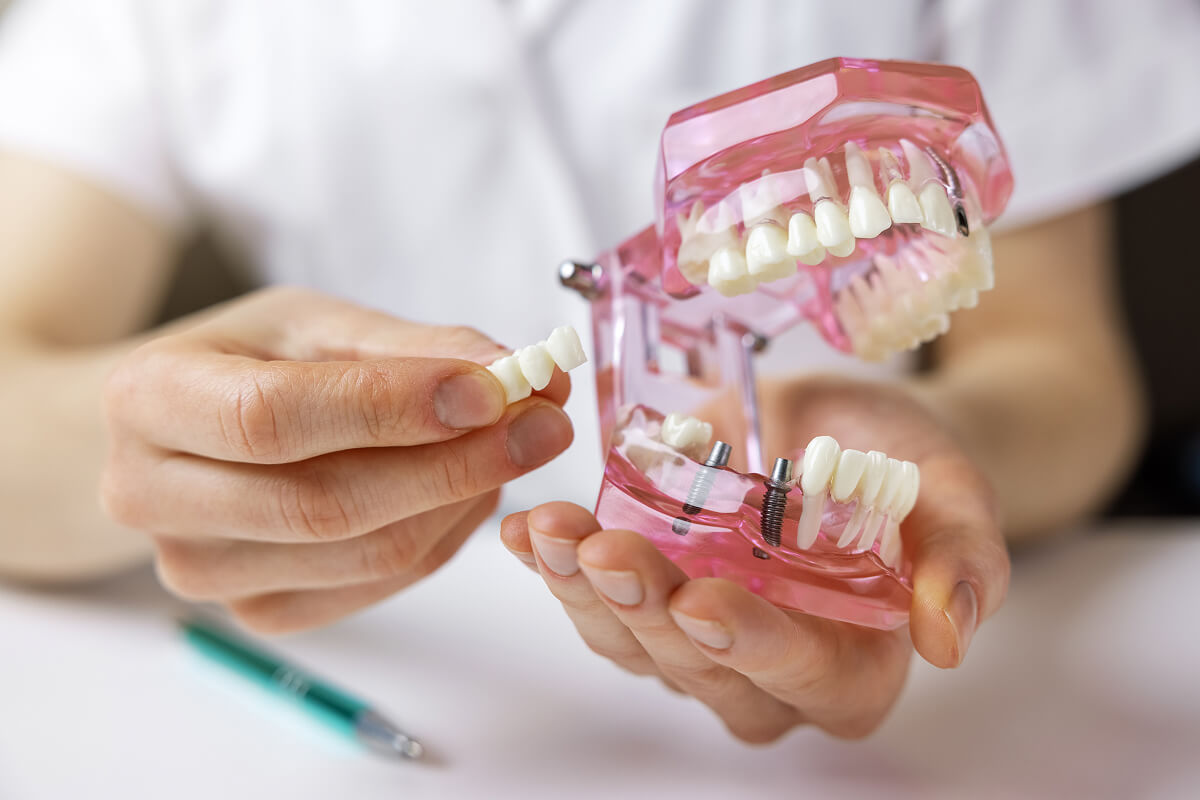 dental implant bridges in cookstown, on
