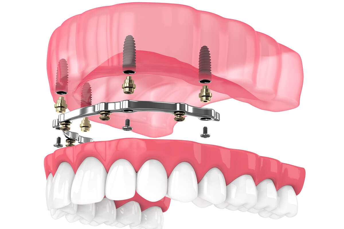implant dentures