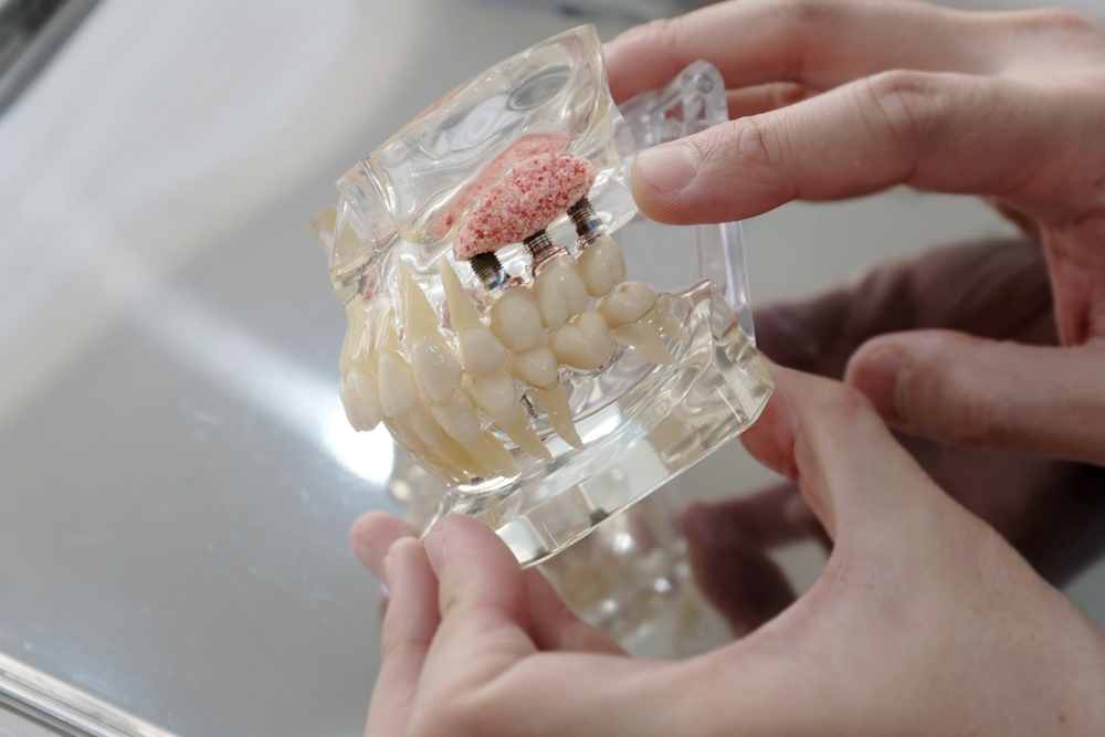 everything you need to know about dental bone grafting
