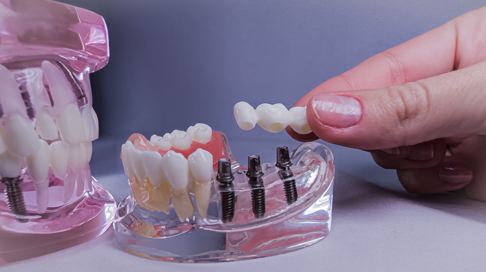 the complete guide to dental implant bridges