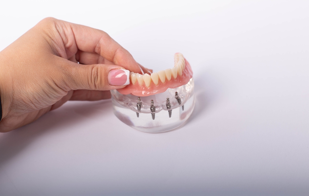 can you eat anything with all four implants